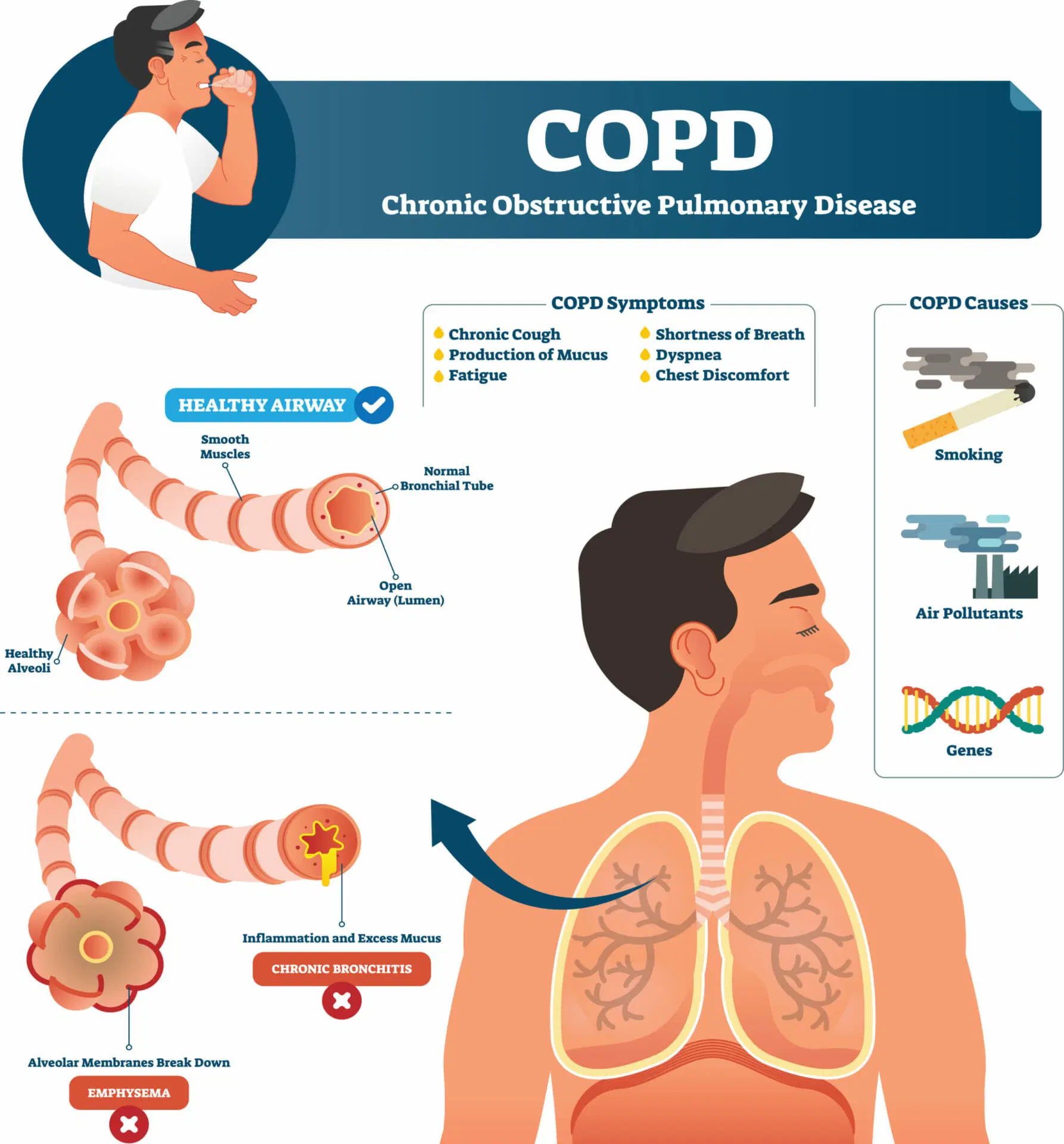 You are currently viewing READING TEST ABOUT COPD