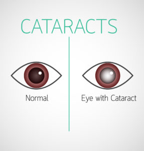 Read more about the article Cataract Signs, symptoms and treatment