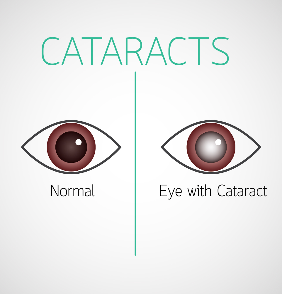 You are currently viewing Cataract Signs, symptoms and treatment