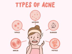 Read more about the article What are the causes and treatments for acne