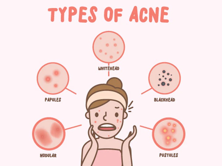 Read more about the article What are the causes and treatments for acne